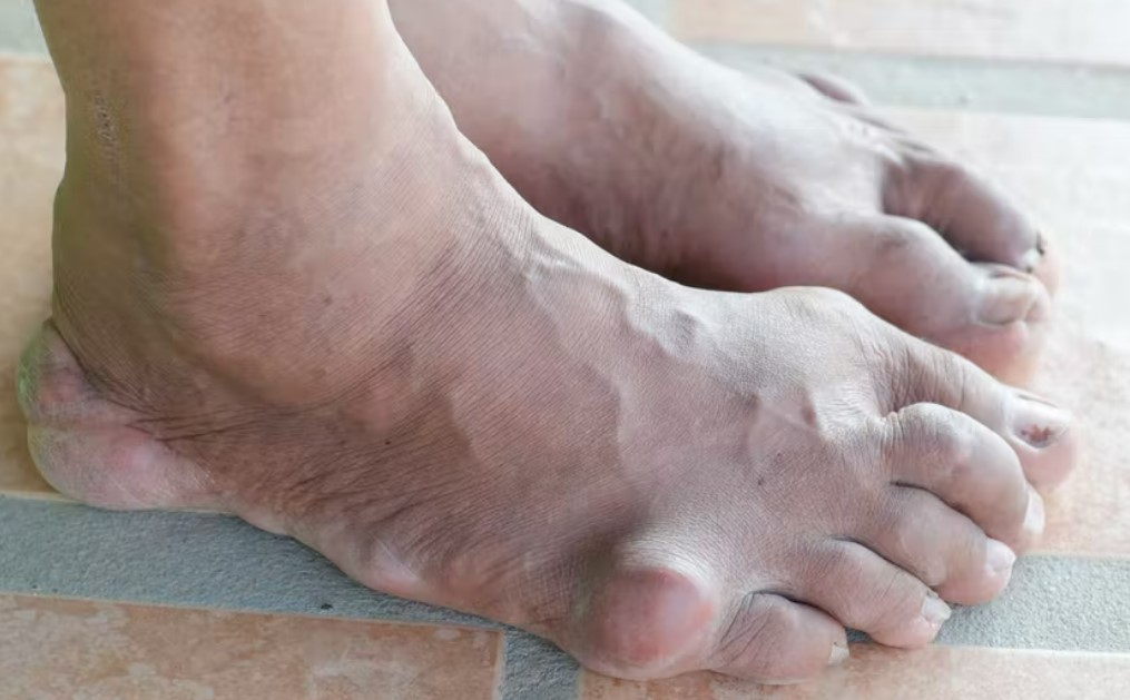 Gout causes