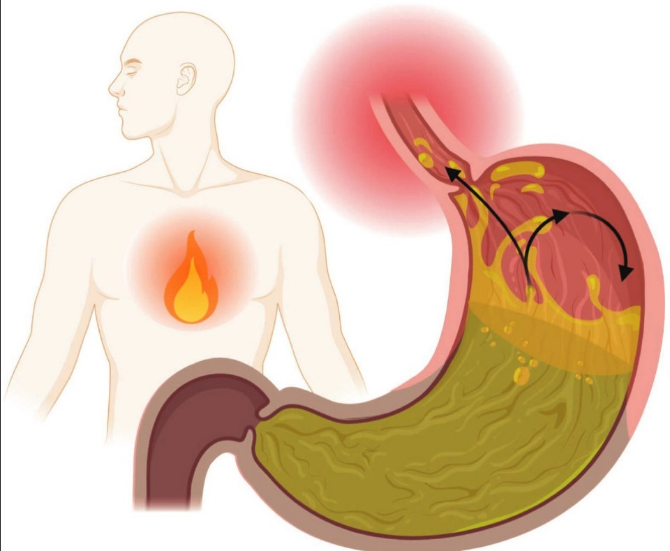 What Causes Acid Reflux